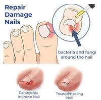 Anti-Fungal Nail Repair Oil